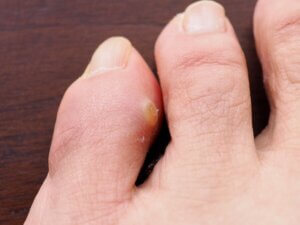 Corn,At,Toe Corn,At,Toe